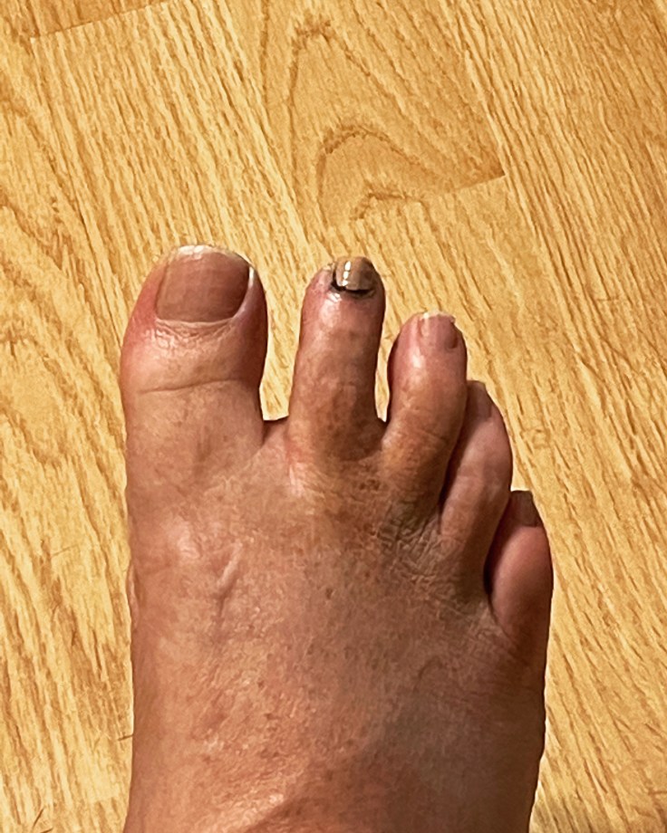 Runners Toe: The&nbsp;Coverup